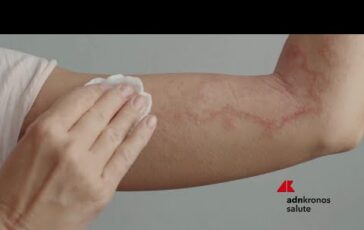 Psoriasi per 15 mln italiani oltre 750 visite gratuite nellOpen day nazionale 364x230