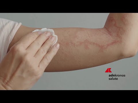 Psoriasi per 1,5 mln italiani, oltre 750 visite gratuite nell’Open day nazionale