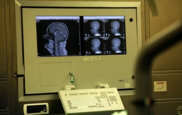 Sogni agitati sintomo Parkinson Medici anti bufale puo accadere si fa polisonnografia 364x230