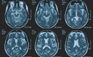 tumori glioma pediatrico di basso grado via libera in europa a prima terapia mirata 2