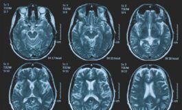 Tumori glioma pediatrico di basso grado via libera in Europa a prima terapia mirata 265x160