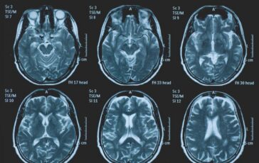 Tumori glioma pediatrico di basso grado via libera in Europa a prima terapia mirata 364x230