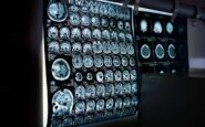 uno spray nasale ferma linvecchiamento del cervello lo studio 2