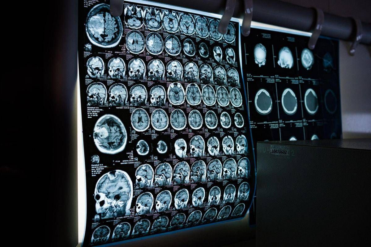 Uno spray nasale ferma l'invecchiamento del cervello, lo studio