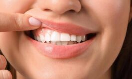 Generazione Z sorrisi social ma gengive malate 1 su 3 ha problemi orali 265x160