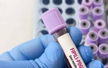 Giornata patologie eosinofile allergologo Caminati Diagnosi complessa 364x230