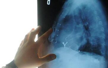 Radiologia interventistica Ssn e fondazioni per cure piu accessibili 364x230
