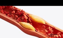 Salute nuove linee guida dislipidemie ‘abbassare e stabilizzare colesterolo 265x160