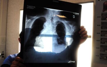 Sirm Ai strumento anti liste dattesa 50 esami imaging per over70 non necessario 364x230
