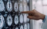 stop tremori parkinson senza bisturi 10 pazienti curati con ultrasuoni a napoli 2
