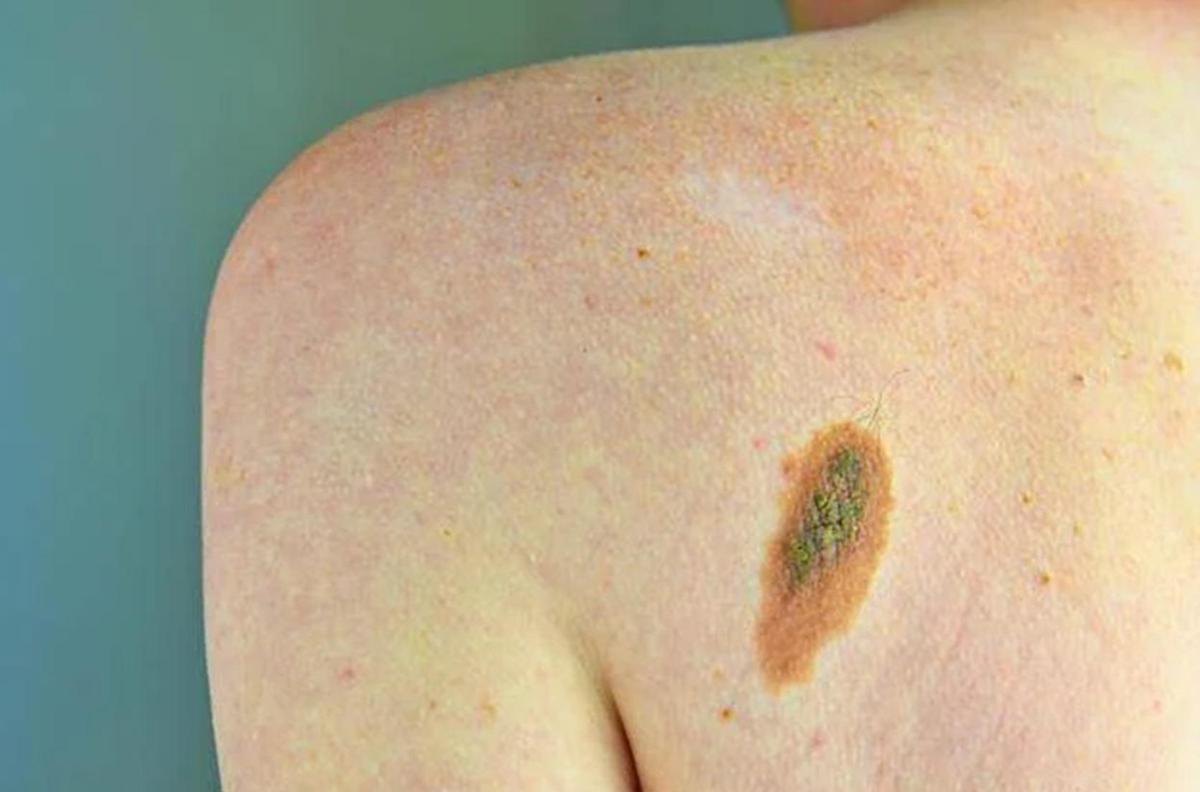 Imi: "Bene legge su prevenzione melanoma, educare i giovani su rischi"