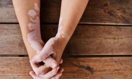 In Senato riflettori puntati sulla vitiligine luce su una malattia vittima di stigma disinformazione e pregiudizi 265x160