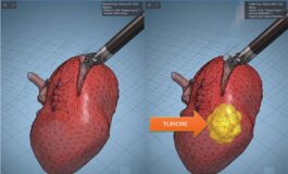 Modelli tridimensionali biomimetici del cancro al rene di un paziente per chirurgia robotica sempre piu precisa 265x160