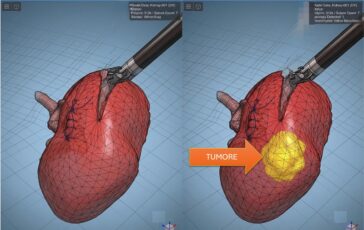 Modelli tridimensionali biomimetici del cancro al rene di un paziente per chirurgia robotica sempre piu precisa 364x230