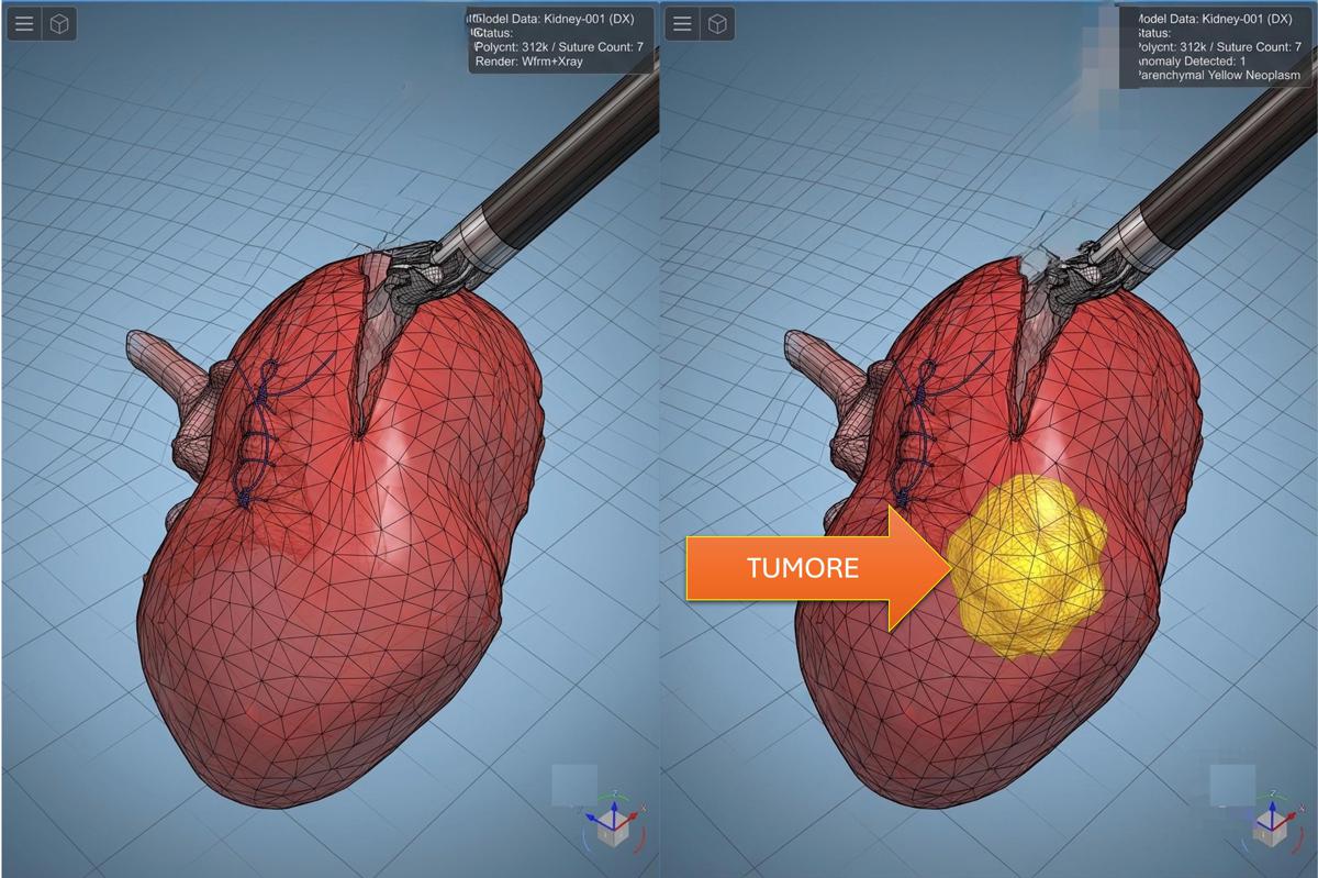 Modelli tridimensionali biomimetici del cancro al rene di un paziente per chirurgia robotica sempre più precisa