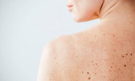 Nei e sole Sidemast lancia la Giornata della prevenzione dermatologica 265x160