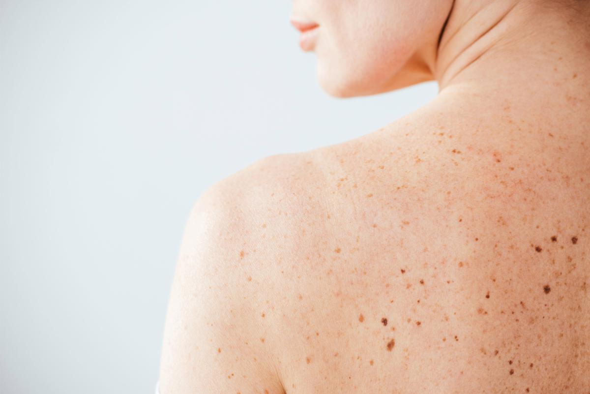 Nei e sole, Sidemast lancia la Giornata della prevenzione dermatologica