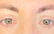 Visione annebbiata o distorta spia di retinopatia. Ne soffre il 30 dei diabetici prevenzione larma piu efficace 185x115