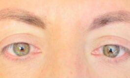 Visione annebbiata o distorta spia di retinopatia. Ne soffre il 30 dei diabetici prevenzione larma piu efficace 265x160