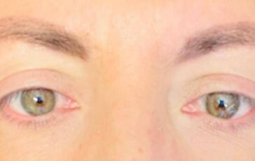Visione annebbiata o distorta spia di retinopatia. Ne soffre il 30 dei diabetici prevenzione larma piu efficace 364x230
