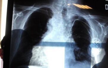 Bpco pneumologa Foschino Barbaro Nella donna sintomi diversi attenzione alle giovani 364x230