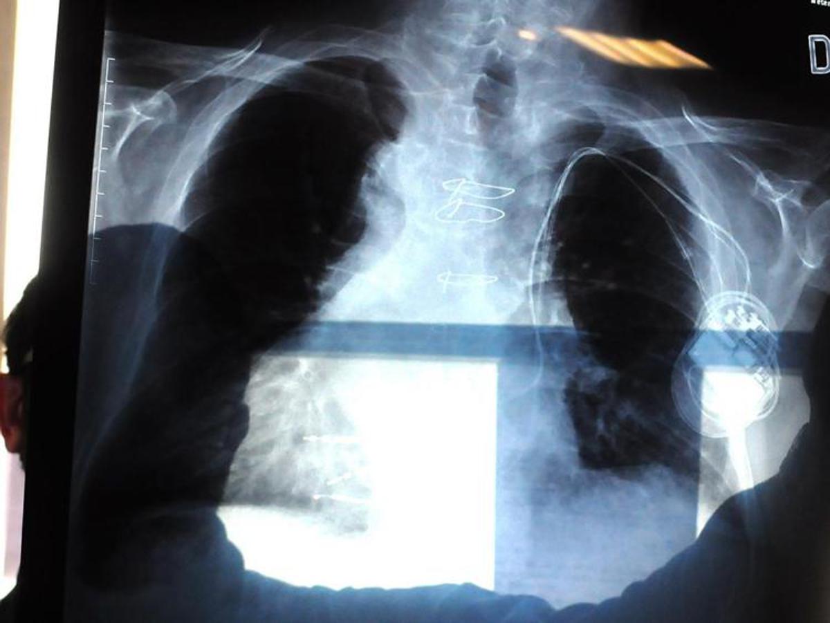 Bpco, pneumologa Foschino Barbaro: "Nella donna sintomi diversi, attenzione alle giovani"