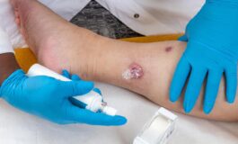 Idrosadenite suppurativa le iniziative di Ucb per migliorare diagnosi e cura 265x160