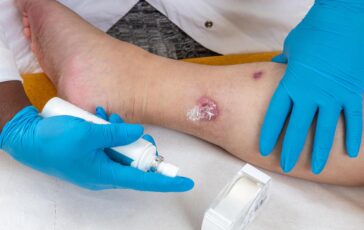 Idrosadenite suppurativa le iniziative di Ucb per migliorare diagnosi e cura 364x230