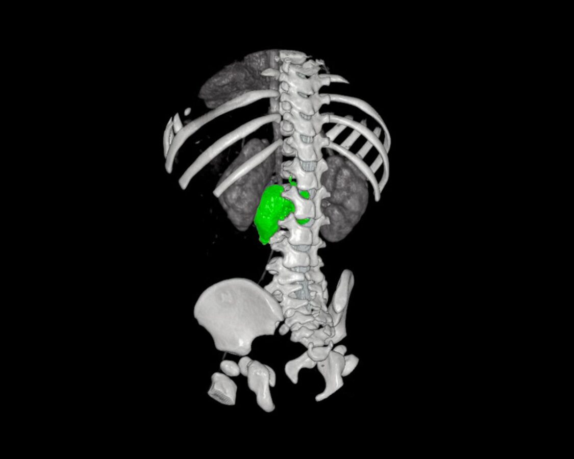 Chirurgia su misura, al Bambino Gesù di Roma rimosso complesso neuroblastoma a bimba di 1 anno