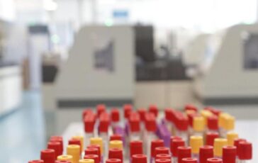 Malaria in aeroporto in Germania gli esperti Campanello dallarme ma il rischio resta contenuto 364x230