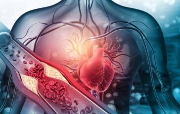 Arterosclerosi studio Nuova molecola riduce di piu il colesterolo cattivo 364x230