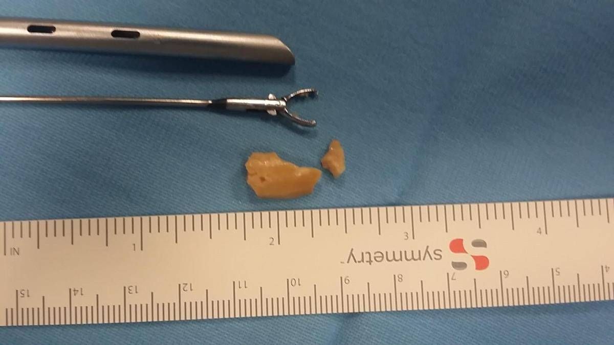 20-month-old baby saved after a hazelnut stuck in her bronchi for two weeks