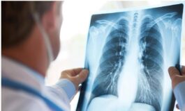 Cancro polmone Egfr mutato studio fase 3 Adaura Il 79 dei pazienti vivo a 8 anni con Osimertinib 265x160