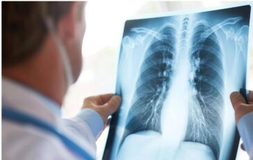 Cancro polmone Egfr mutato studio fase 3 Adaura Il 79 dei pazienti vivo a 8 anni con Osimertinib 364x230