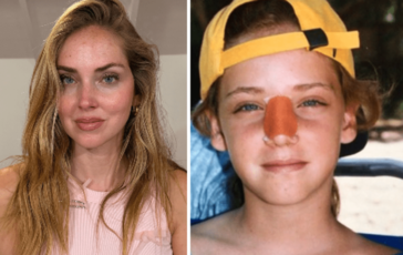 Chiara Ferragni lintervento al naso Ecco perche e storto ora 364x230