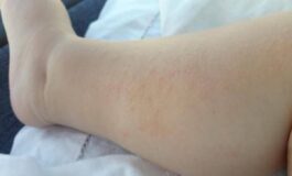 Dermatite atopica Aifa estende rimborso di upadacitinib dai 12 anni di eta 265x160