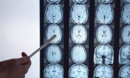 Di Battista e il tumore al cervello in Italia circa 6mila diagnosi ogni anno quali sono i sintomi spia 265x160