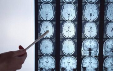 Di Battista e il tumore al cervello in Italia circa 6mila diagnosi ogni anno quali sono i sintomi spia 364x230