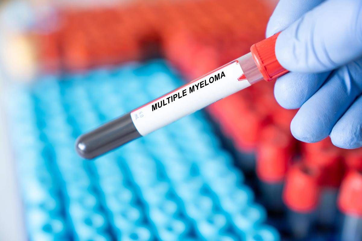 Mieloma multiplo, remissione a 5 anni con terapia Car-T cilta-cel in linee precoci