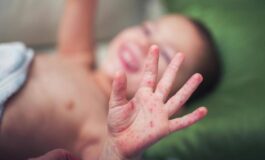 Morbillo aumentano casi e ricoveri. Bassetti In Liguria focolaio senza precedenti lItalia rischia gravissima epidemia 265x160