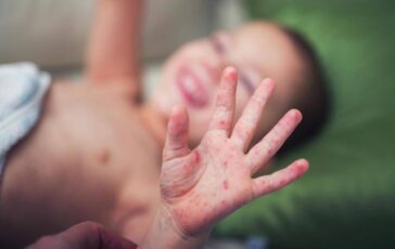 Morbillo aumentano casi e ricoveri. Bassetti In Liguria focolaio senza precedenti lItalia rischia gravissima epidemia 364x230