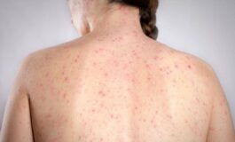 Morbillo e allarme negli Usa. Italia prima per casi in Europa in in primi 6 mesi 2026 265x160