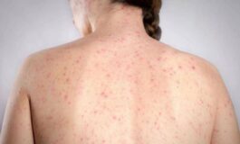 Morbillo lallarme dellinfettivologo Andreoni Casi in crescita ricoveri frequenti negli adulti 265x160