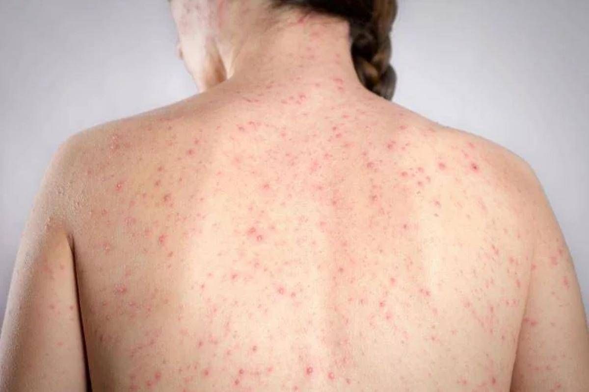 Morbillo, l'allarme dell'infettivologo Andreoni: "Casi in crescita, ricoveri frequenti negli adulti"