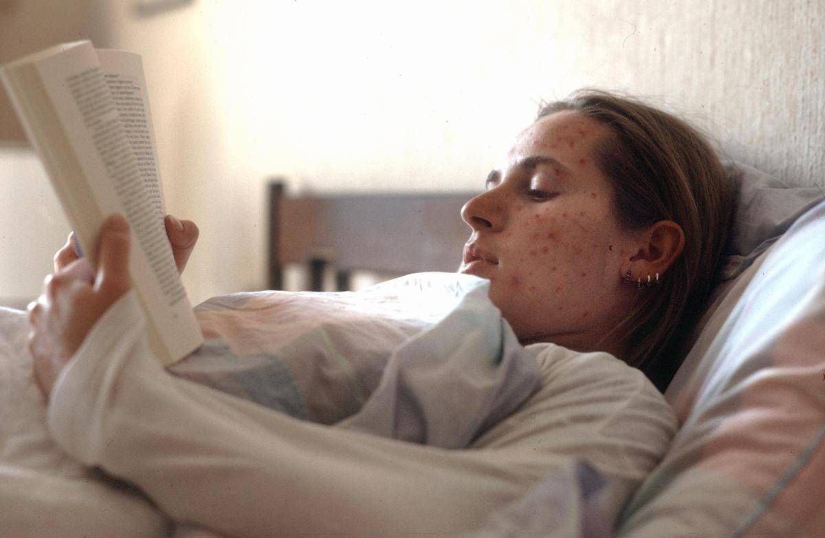 Morbillo, l'appello di Pregliasco: "Può avere effetti gravi, bisogna prevenire contagio"