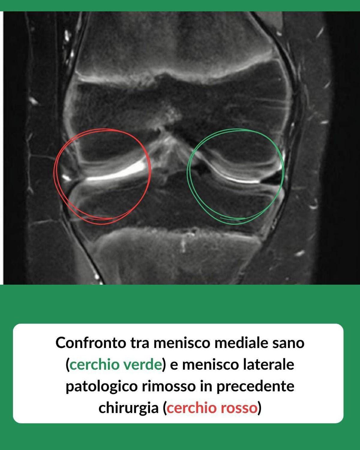Tornare a camminare con un trapianto: a 12 anni riceve un menisco da donatore deceduto, intervento in artroscopia a Treviglio (Bg)