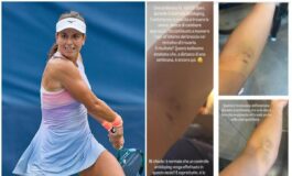 US Open Stefanini e il livido sul braccio Colpa di un controllo antidoping 265x160