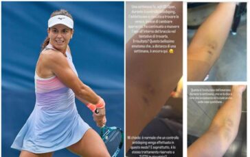 US Open Stefanini e il livido sul braccio Colpa di un controllo antidoping 364x230