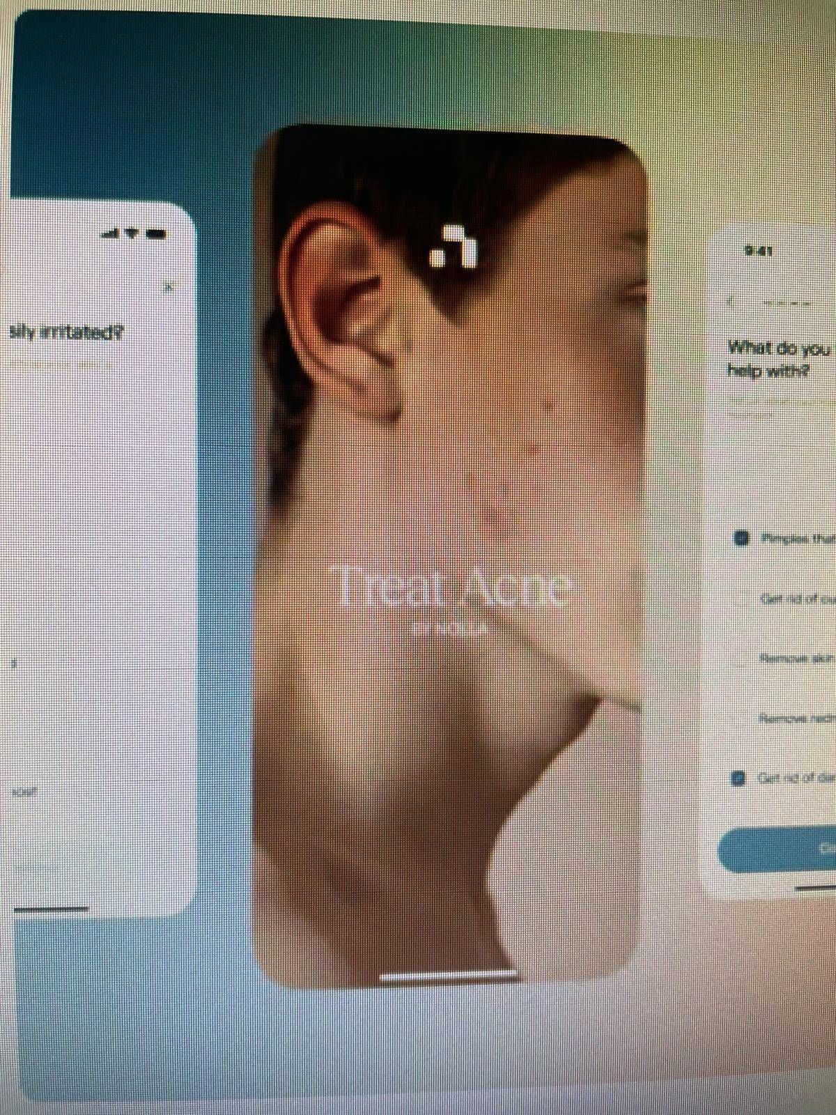 Ai prescrive farmaci contro l'acne, esperti Siiam: "Progresso in Medicina non si misura dal numero di decisioni automatizzate, ma dai benefici concreti per i pazienti"