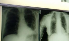 Cancro polmone con nuova combinazione malattia sotto controllo piu a lungo 265x160